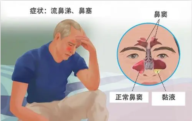 中医体质辨识仪厂家浅析中医中如何治疗鼻窦炎