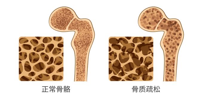 了解骨密度及如何增强骨强度